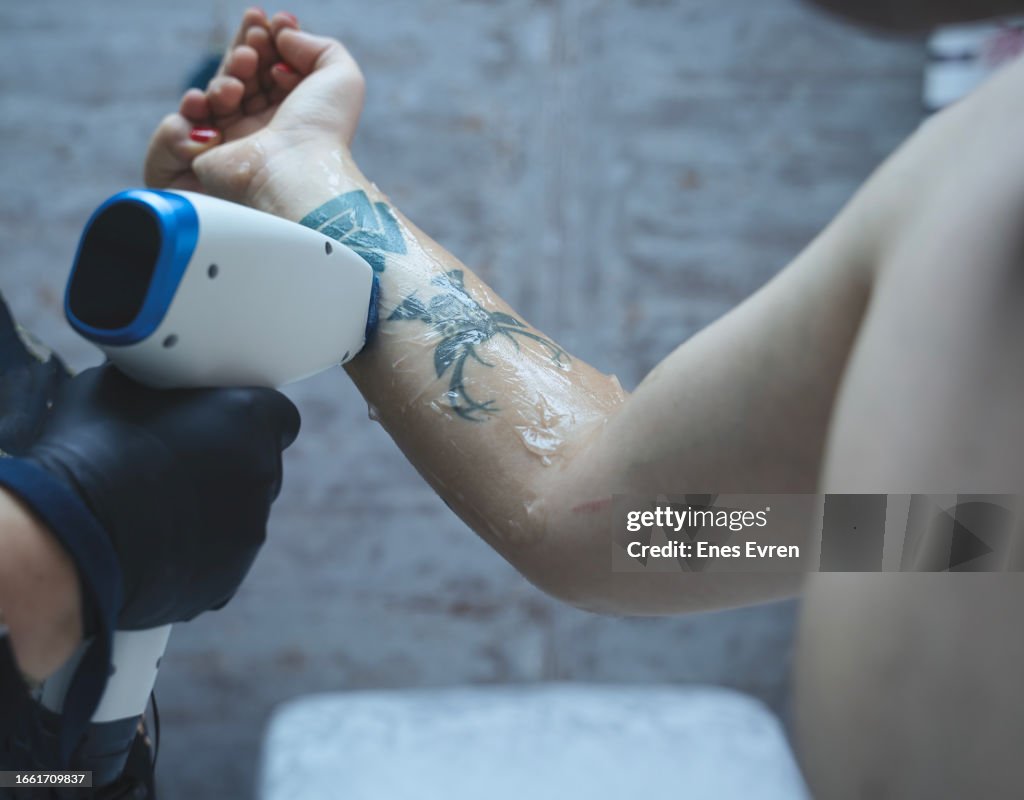 Tattoo removal