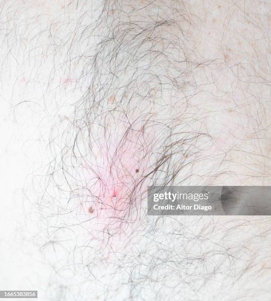 appearance of the wound on a man after removing a tick attached to his skin.. germany - zecca bruna del cane foto e immagini stock