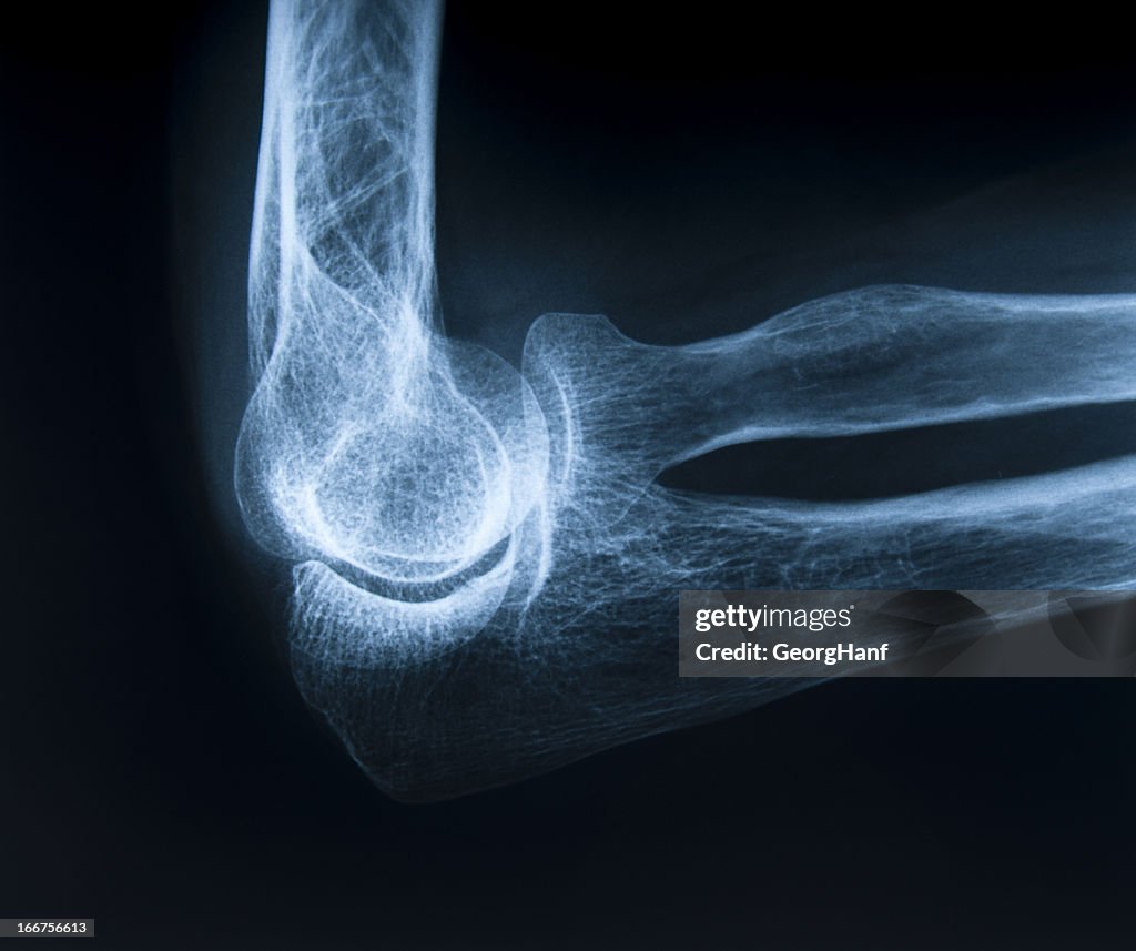 Human elbow bone
