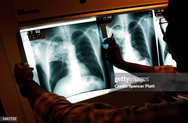 Doctor examines the x-rays of a tuberculosis patient at a TB clinic Novmeber 27, 2002 in Brooklyn, New York. Healthcare workers around the country...