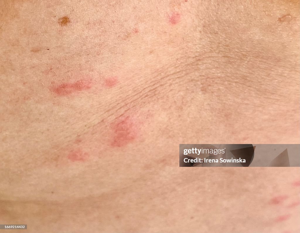Sandfly bites