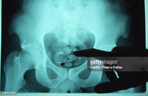 An x-ray image of the stomach filled with heroin of a man..