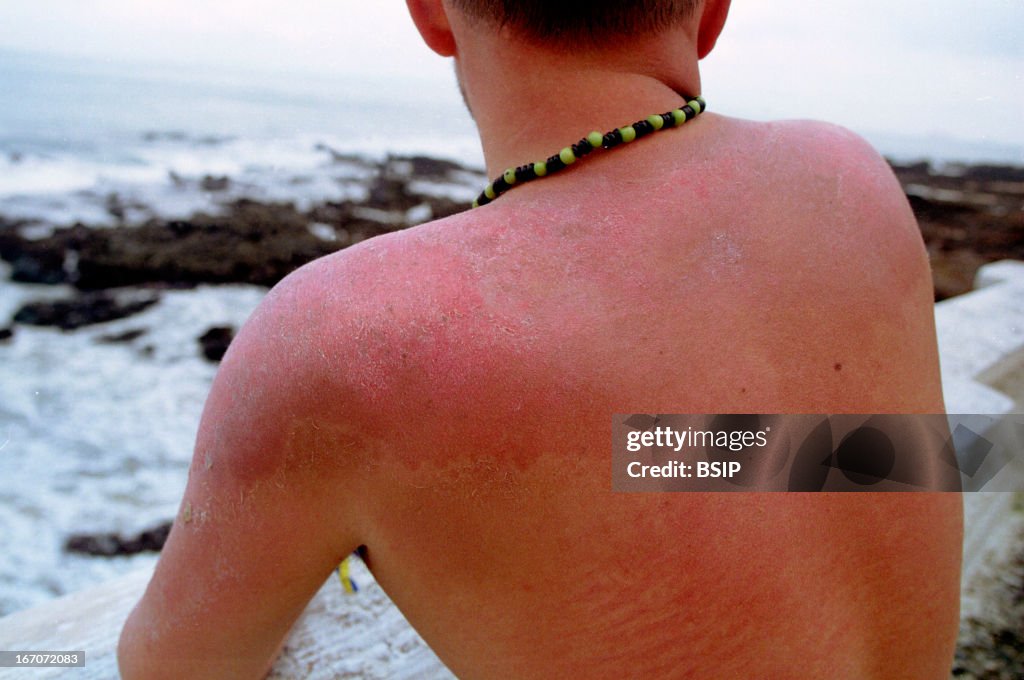 Sunburn