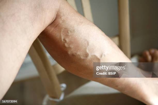 Varicose vein on a leg, Troncular vein on the left leg. The troncular varicose veins are the ones developping on the trunk of the saphenous veins,...