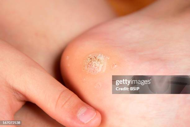 Plantar wart, Model. 12 year old child with plantar warts.