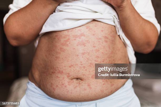 close-up view of plump woman stomach with red itchy rash - skin rash stock pictures, royalty-free photos & images