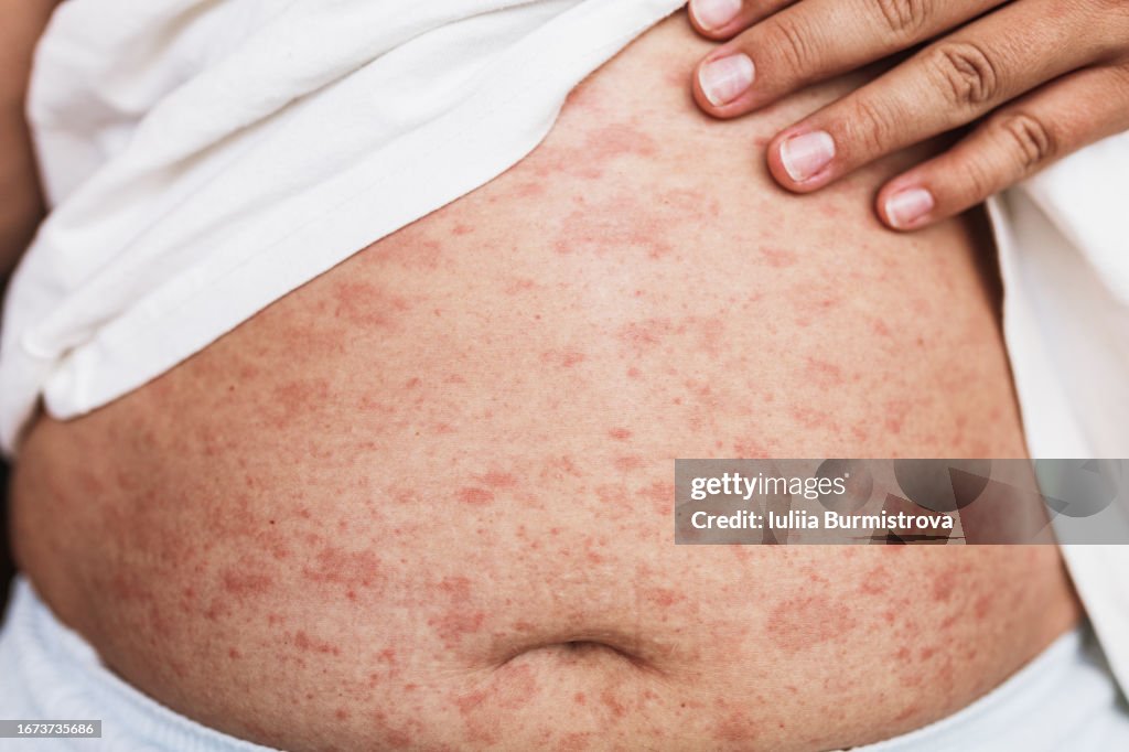 Close-up image of stomach of full-bodied woman with severe case of skin allergy