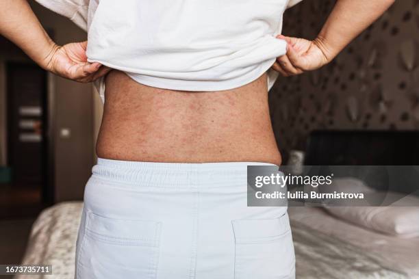 overweight woman standing in bedroom, lifting shirt to reveal back covered in red hives caused by psoriasis - thorax stock pictures, royalty-free photos & images