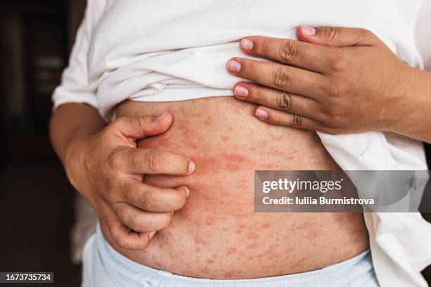 close-up view of plump woman stomach, covered in red, itchy rash with fingers scratching inflamed skin - man standing full body stock-fotos und bilder