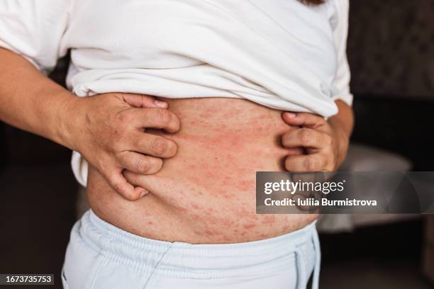 close-up view of overweight woman scratching torso covered in red rash caused by bad habits and high level of stress - ausschlag stock-fotos und bilder