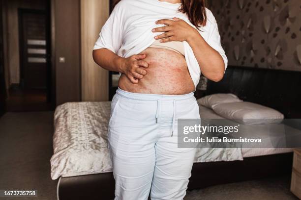 plus-size woman standing in bedroom and scratching exposed stomach with severe case of skin fungus - skin fungus stock pictures, royalty-free photos & images