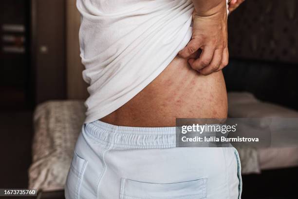 plus-size woman lifting shirt to scratch back, covered in red, itchy rash and feeling vulnerable - man standing full body stock-fotos und bilder