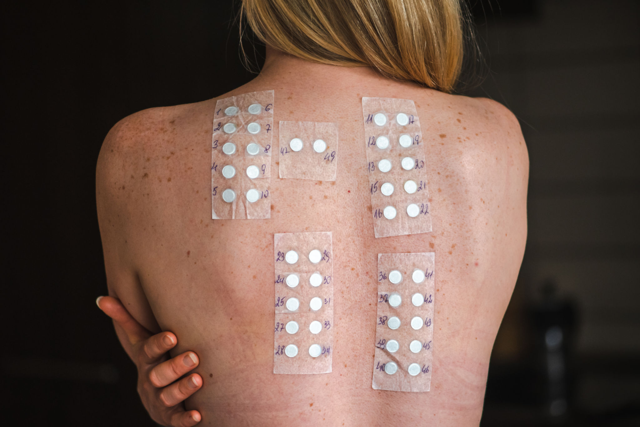 skin patch test