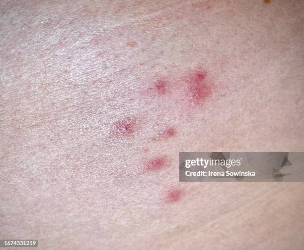 Red Bug Bite Photos And Premium High Res Pictures Getty Images red-bug-bite-photos-and-premium-high-res-pictures-getty-images