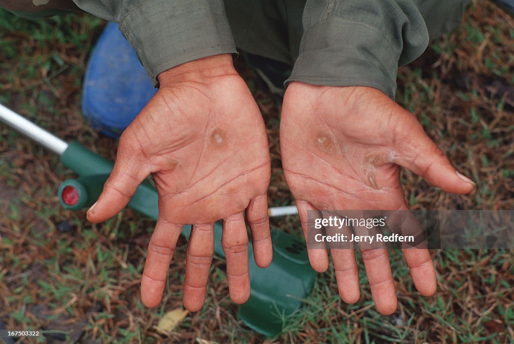 Khin Reth, 35, shows the wounds from  "walking" on crutches...