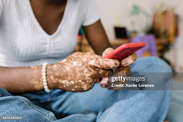 close up view of young woman with vitiligo using cell phone relaxing on bed. technology and social media concept. - interface dots stock pictures, royalty-free photos & images