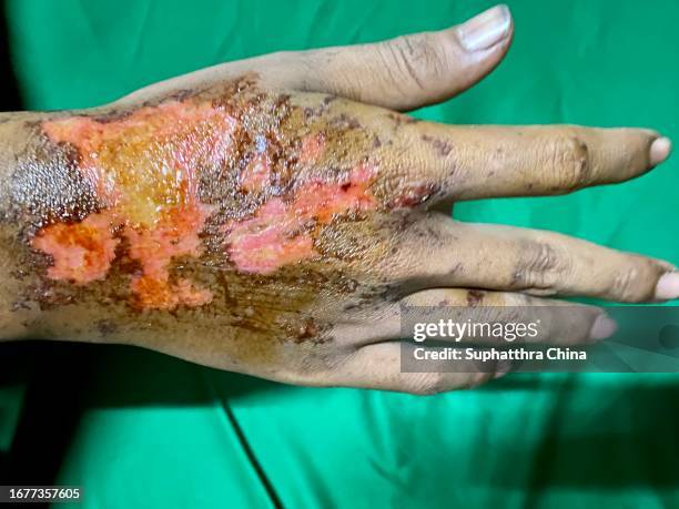 wound on back of mam hand because of motorcycle accident - ulcera foto e immagini stock