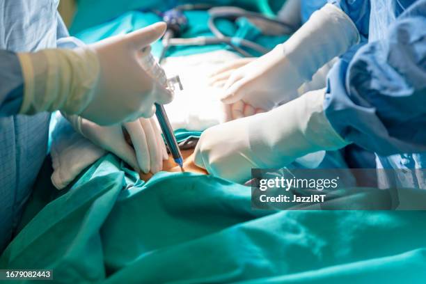 a surgeon in latex gloves and a blue uniform holds special medical instruments during a laparoscopic operation. - colon stockfoto's en -beelden