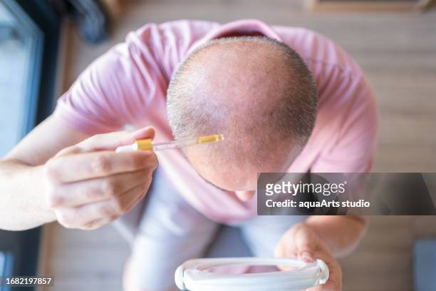 baldness treatment - completely bald bildbanksfoton och bilder