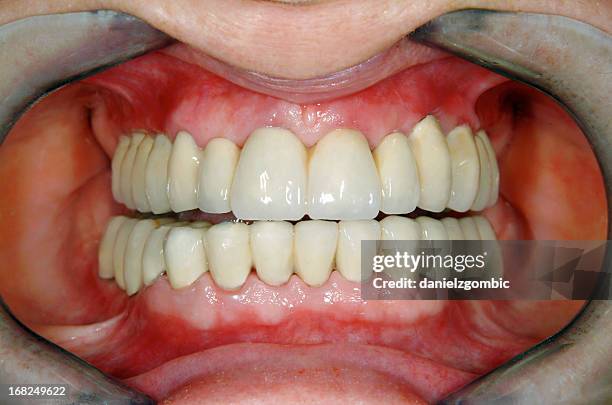 after full dental reconstruction - before and after teeth stock pictures, royalty-free photos & images