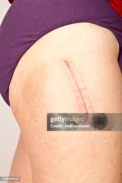 künstliches hüftgelenk chirurgie scar - knee surgery stock-fotos und bilder