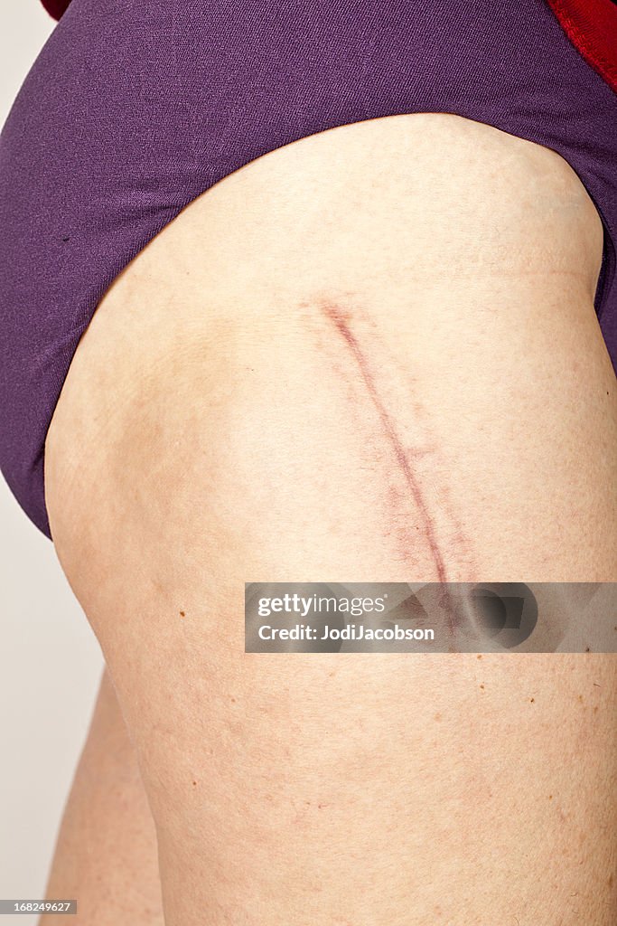 Hip replacement surgery scar