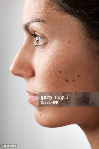 portrait of a woman with melanoma moles and freckles (xxxl) - mole stockfoto's en -beelden