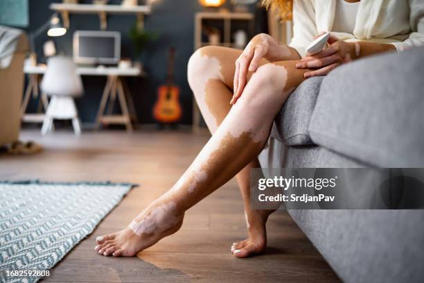 unkenntliche frau mit vitiligo, die körpercreme auf ihre beine aufträgt - vitiligo stock-fotos und bilder