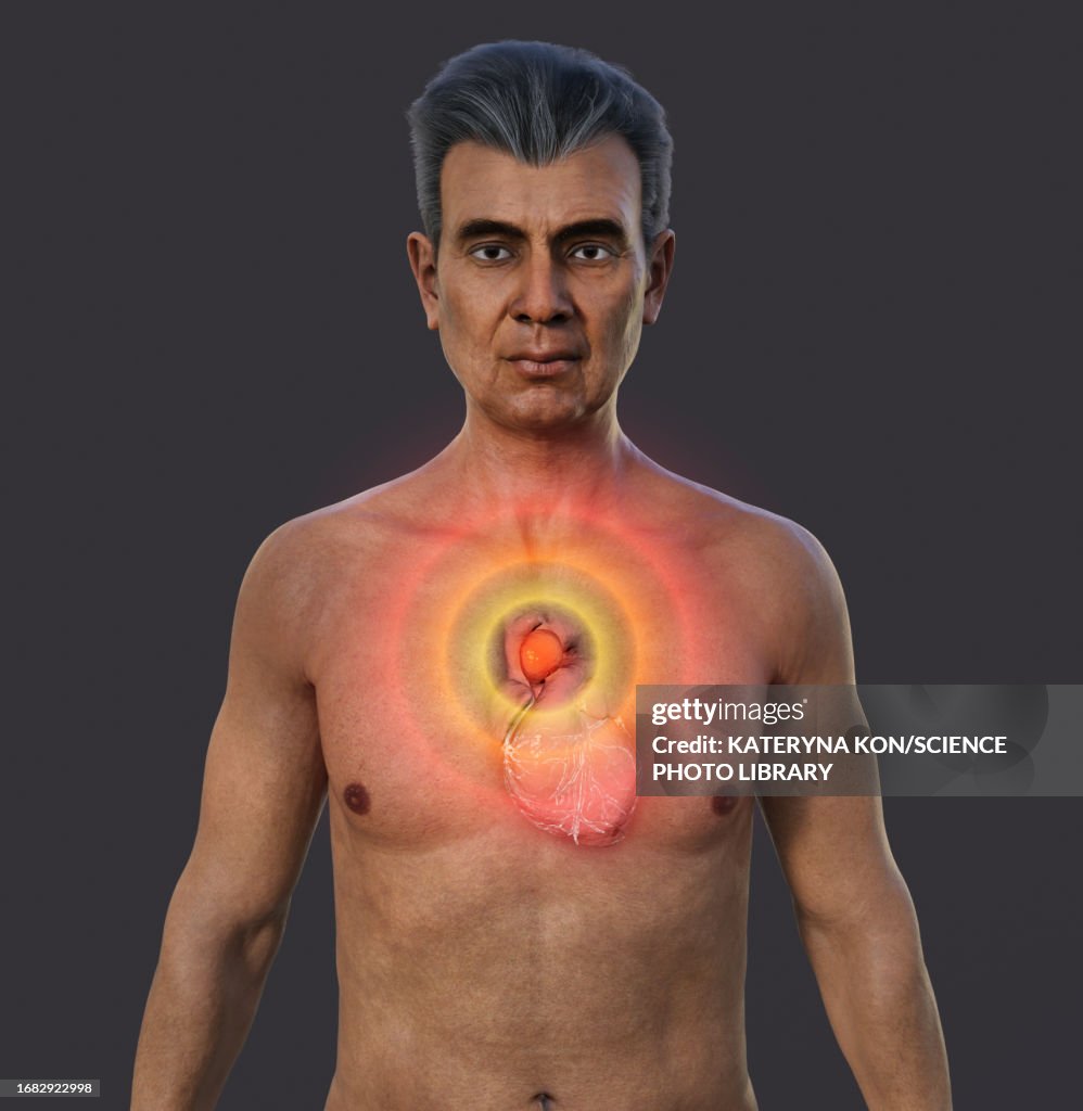 Ascending Aortic Aneurysm Illustration High-Res Vector Graphic - Getty ...
