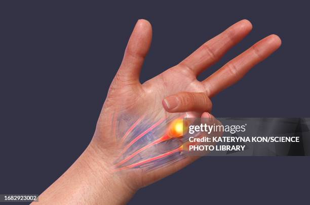 dupuytren's contracture, illustration - deformed hand stock illustrations