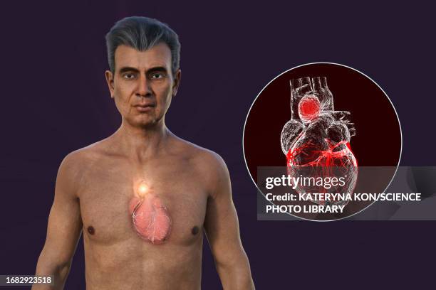 Ascending Aortic Aneurysm Illustration High-Res Vector Graphic - Getty ...