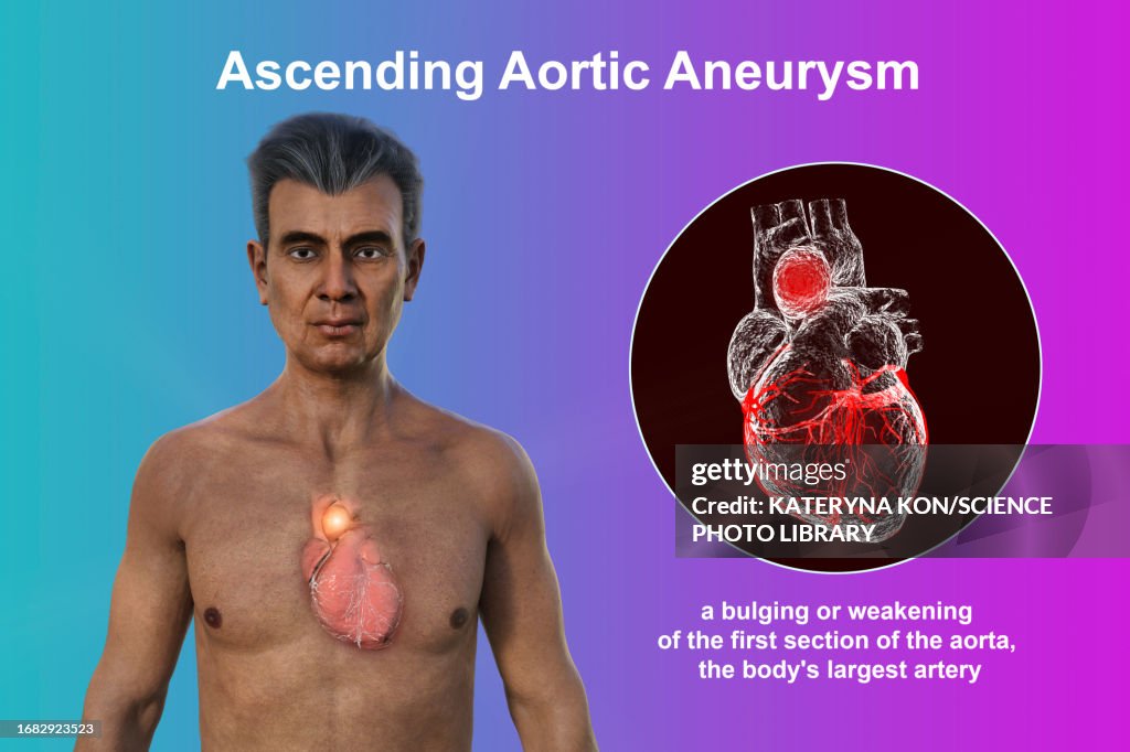 Ascending Aortic Aneurysm Illustration High-Res Vector Graphic - Getty ...
