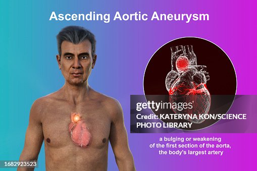 Ascending Aortic Aneurysm Illustration High-Res Vector Graphic - Getty ...