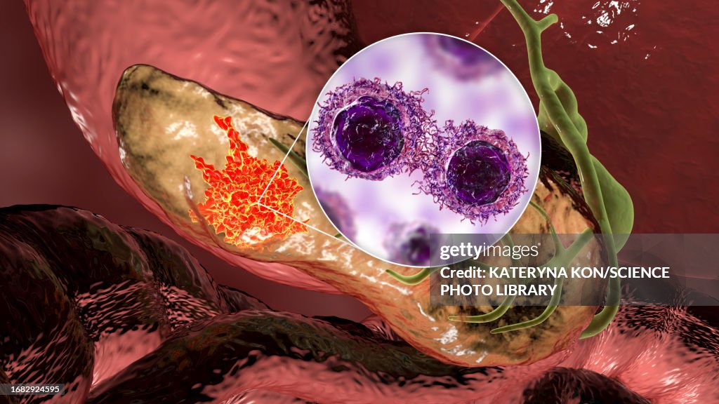 Pancreatic cancer, illustration