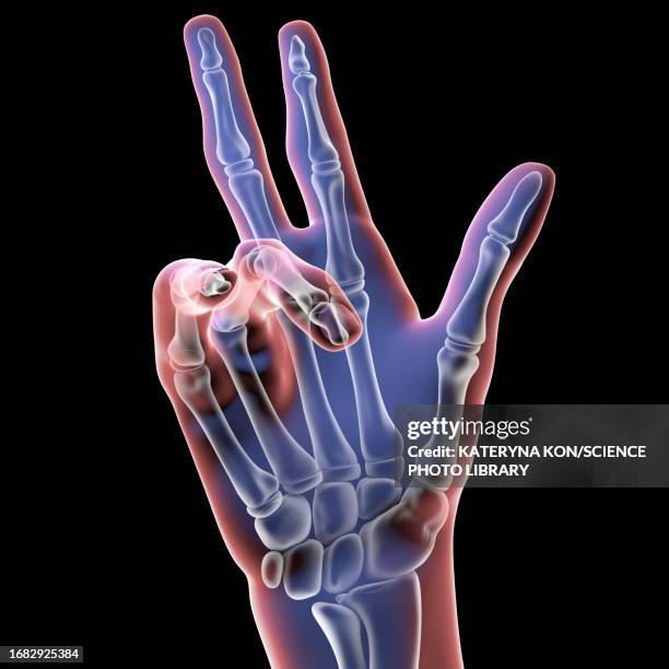 dupuytren's contracture, illustration - deformed hand stock-grafiken, -clipart, -cartoons und -symbole