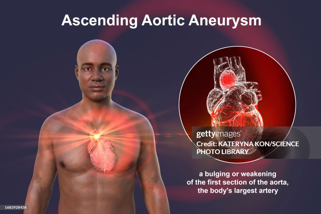 Ascending Aortic Aneurysm Illustration HighRes Vector Graphic Getty