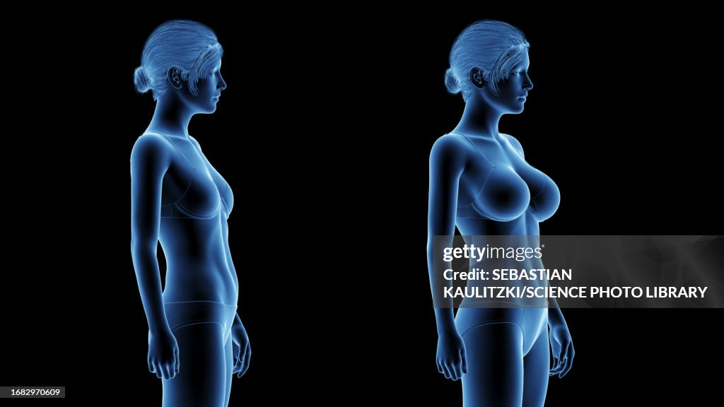 Woman after breast enlargement, illustration