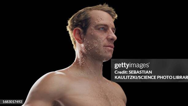 22 Smallpox Rash Stock Photos, High-Res Pictures, and Images - Getty Images