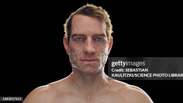 smallpox infection, illustration - human skin close up stock illustrations