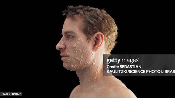 15 Smallpox Rash High Res Illustrations - Getty Images