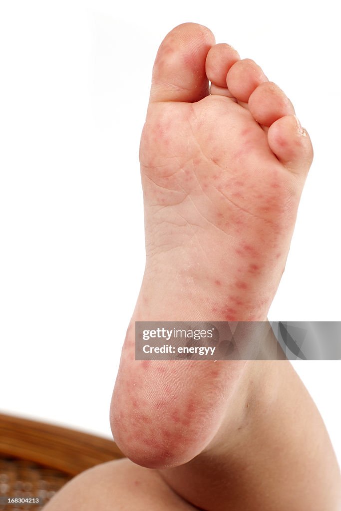 Foliculite em Child's Foot
