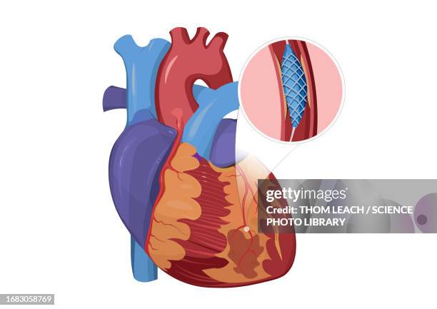 human heart with stent, illustration - stenosis stock illustrations