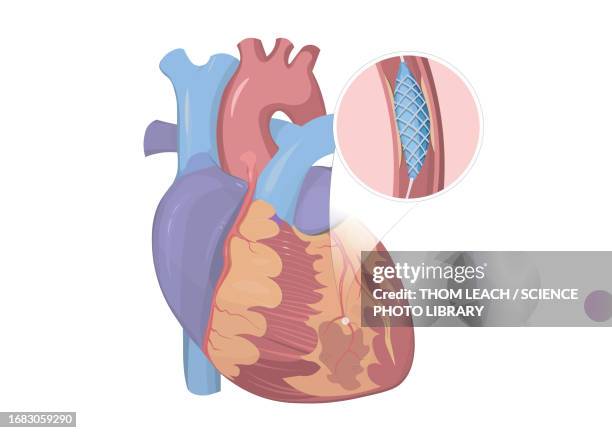 ilustrações de stock, clip art, desenhos animados e ícones de human heart with stent, illustration - aorta