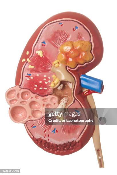 deseased kidney auf weißem hintergrund - anatomisches modell stock-fotos und bilder