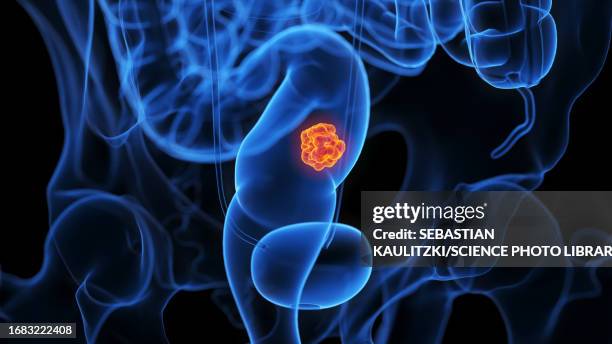 rectum tumour, illustration - irritation stock illustrations