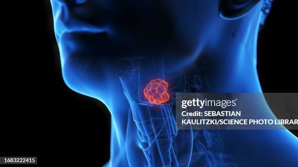 ilustrações, clipart, desenhos animados e ícones de larynx tumour, illustration - traqueia aparelho respiratório