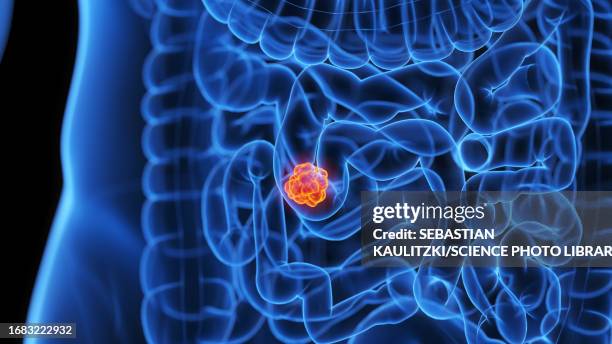 intestine tumour, illustration - displeased stock illustrations