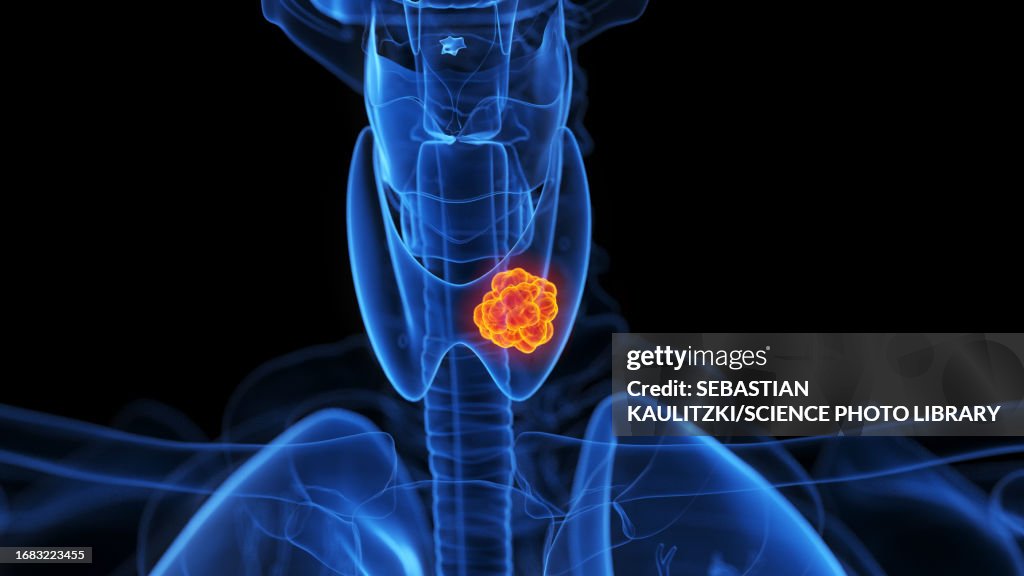 Thyroid tumour, illustration