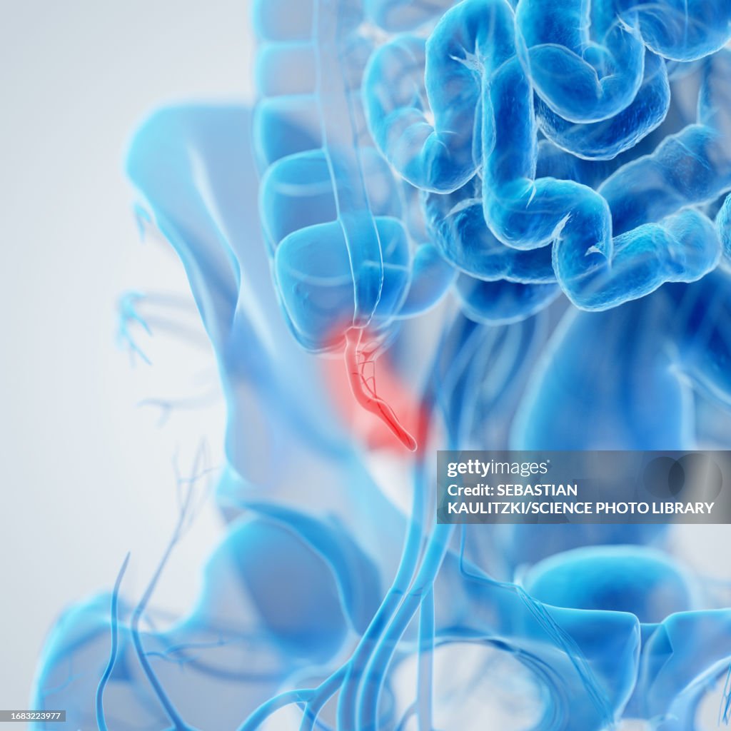 Inflamed Appendix Illustration High-Res Vector Graphic - Getty Images