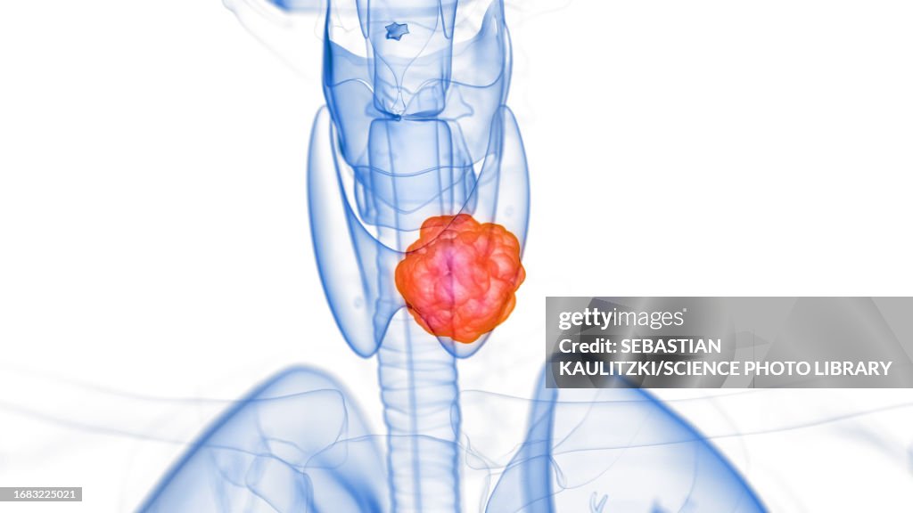 Thyroid tumour, illustration